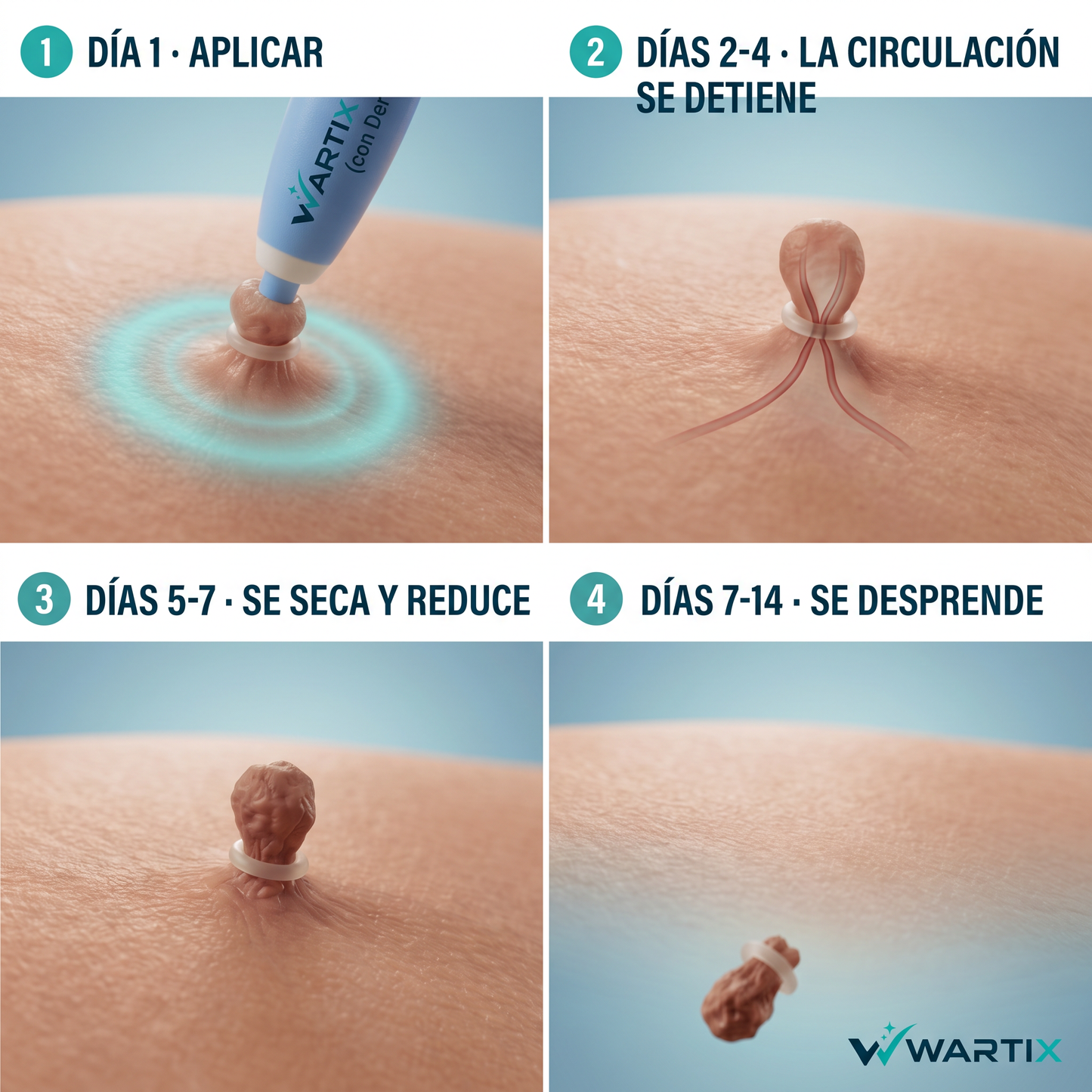 Eliminador de Verrugas sin Dolor